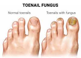 toenail fungus laser treatment in new