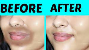 remove dark patches around mouth area