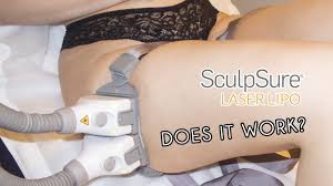 laser lipo sculpsure review you
