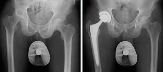 anterior hip replacement surgery