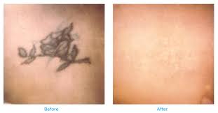 Black and dark green are the easiest colors to remove; Permanently Remove Unwanted Tattoos With Laser Tattoo Removal In Nh