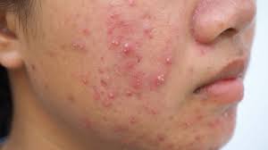 cystic acne explained causes symptoms