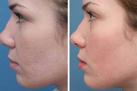 acne scar treatment chicago il dr