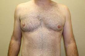 Common symptoms of poland syndrome include the partial or complete absence of chest muscles and tissue, as well as abnormalities of the arms, hands, and fingers. Before And After Galleries Polands Syndrome