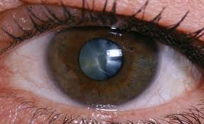 Как лечить катаракту в домашних условиях или в медицинском центре Images?q=tbn:ANd9GcQ74zNUicchMhgMWThyF9gT9-TNKwE-BjfQAvyr04t4xLEYgidBUQ&s