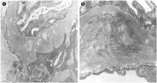 electron micrographs of renal biopsy