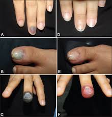 2018 2 31 hematoma our dermatology