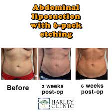 liposuction vs tummy tuck which one is