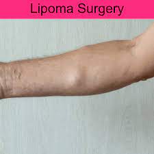 best cost for lipoma removal at ni