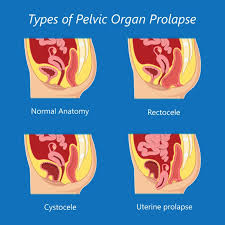 prolapses and the pelvic floor