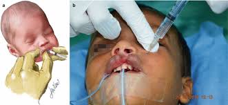 anesthesia for patients with cleft lip