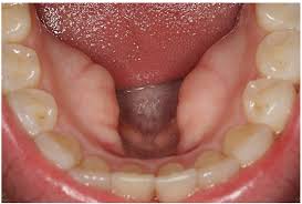 normal cavity findings and