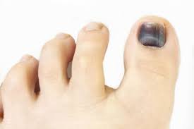 how to get rid of toenail fungus 5