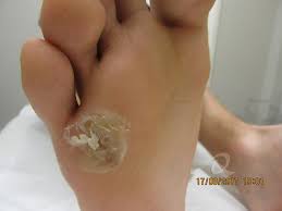 b a photos of warts removal treatment