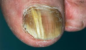 four nail disorders every clinician