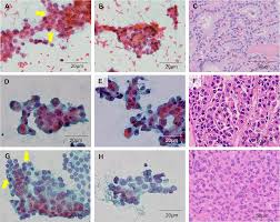 Fine needle aspiration cytology (fnac); Plos One Preoperative Diagnostic Categories Of Fine Needle Aspiration Cytology For Histologically Proven Thyroid Follicular Adenoma And Carcinoma And Hurthle Cell Adenoma And Carcinoma Analysis Of Cause Of Under Or Misdiagnoses