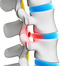 herniated and bulging disc first