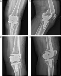 periprosthetic distal fem fractures