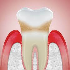 If your gingivitis doesn't go away. What Causes Receding Gums Corsodyl