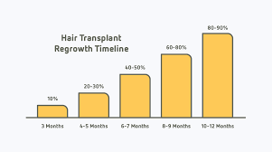28 Albums Of Transplant Hair Growth Timeline Explore