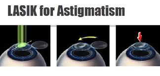 lasik for astigmatism how it helps