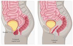 surgical solutions for prolapse