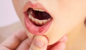 canker sores sabka dentist top