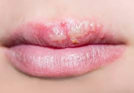 cold sores herpes simplex virus