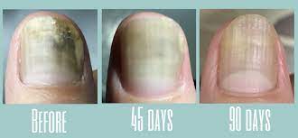 nails from nail fungus infection