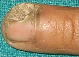 surgical nail avulsion