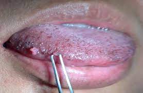 mouth and canker sores