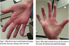 Frequently, it also affects the sole region of the feet. Unilateral Palmar Erythema A Sequela Of Thoracic Outlet Syndrome The Dermatologist