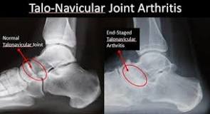 Where is the Talonavicular joint?