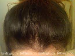 Hypothyroidism, or underactive thyroid, can cause many symptoms, from weight gain to fatigue linked to reduction in metabolism. I Stopped Taking Synthroid 2 5 Years Ago And I M Still Having Female Hair Loss Wrassman M D Baldingblog
