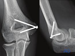 Posterior elbow dislocation transmitting force to the medial epicondyle via the ulnar collateral ligament (most common; Orif Screw Fixation For Extraarticular Avulsion Of Medial Epicondyle