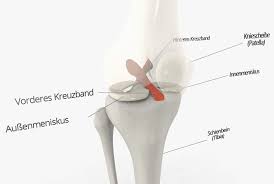 Die lage der knieschmerzen (innen das verdrehen des kniegelenks kann verschiedene strukturen im knie schädigen. Schmerzen Im Knie Ursachen Therapie Knorpelexperte De