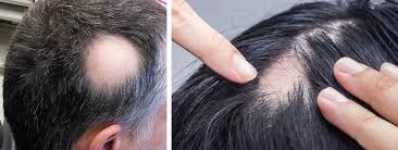 can you get alopecia areata treatment