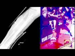 I wish him and his. Paul George Injury X Ray Broken Leg Paul George Breaks Leg Usa Team Game Youtube