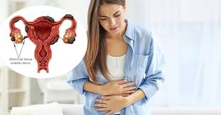 Endometriosis is a gynaecological condition associated with menstruation where tissue similar to the lining of the womb is found in other areas of the body, including the fallopian tubes, pelvis, bowel. You Vs Endometriosis Endometriosis Treatment Nyc
