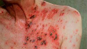 what can be mistaken for shingles