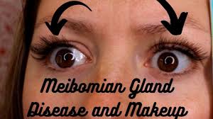meibomian gland disease and makeup lash