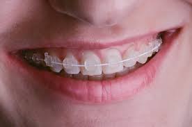 If the clear invisalign trays are not worn the recommended amount of time, your diastema may remain. Clear Braces Vs Invisalign Which Is Better For You