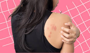what is a stress rash and how to deal