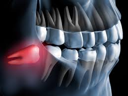 Generally, in case of a simple tooth extraction, it may take about 3 to 4 weeks for the gums to heal completely1. Wisdom Tooth Extraction Can This Cause Teeth To Become Misaligned