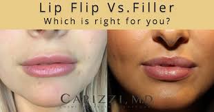 lip flip or lip filler which is