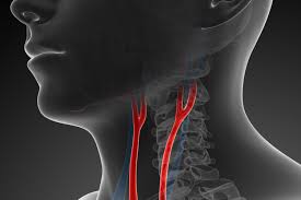Carotid arteries are located in the anterior of the neck, on either side. Carotid Arteries
