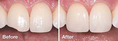 Any dentist can bond your teeth, you want to make. Tooth Bonding Furumoto Dentistry Diamond Bar California