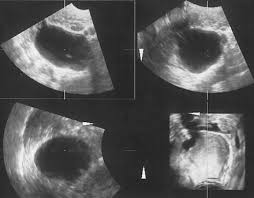 When this process begins, there may be no or only vague symptoms. Diagnostic Ultrasound In The Assessment Of The Adnexal Mass Glowm