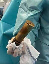 88 yo french man evacuated a whole hospital because he had a WW1 shell  stuck in his anus (full article and source in comments) :  r/Damnthatsinteresting