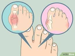 soak an ingrown toenail in epsom salt